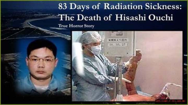 Tragic Tale Of Hisashi Ouchi: Radiation Poisoning's Gruesome Toll